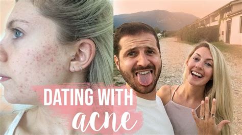 Acne and dating reddit